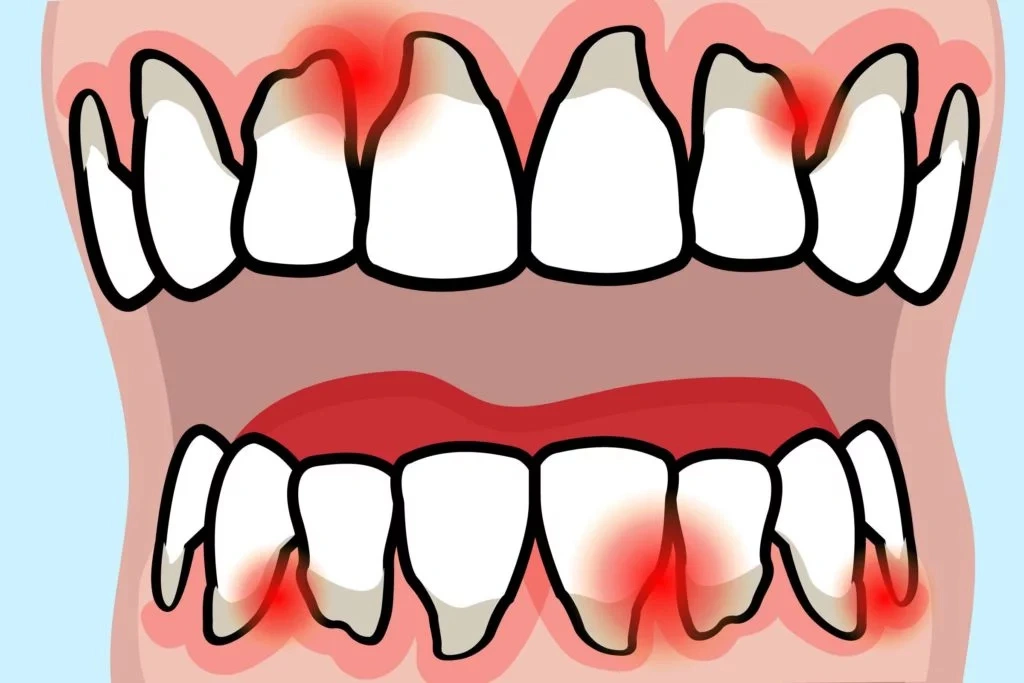 Dental Health and Rheumatoid Arthritis: Tips
