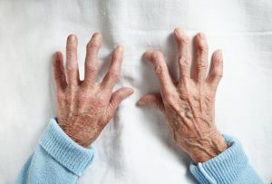 The Difference Between Osteoarthritis Rheumatoid | Aaria Rheumatology Osteoarthritis and rheumatoid arthritis in hands