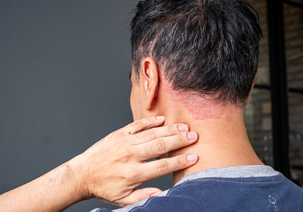 A man suffering from a drug-induced autoimmune reaction