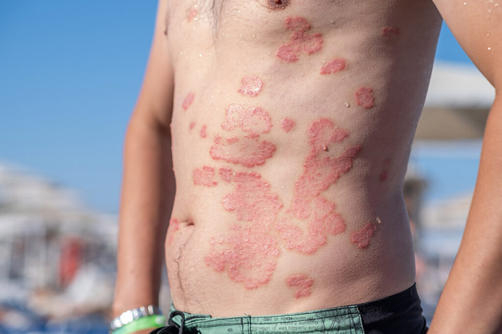 A man suffering from severe skin rashes
