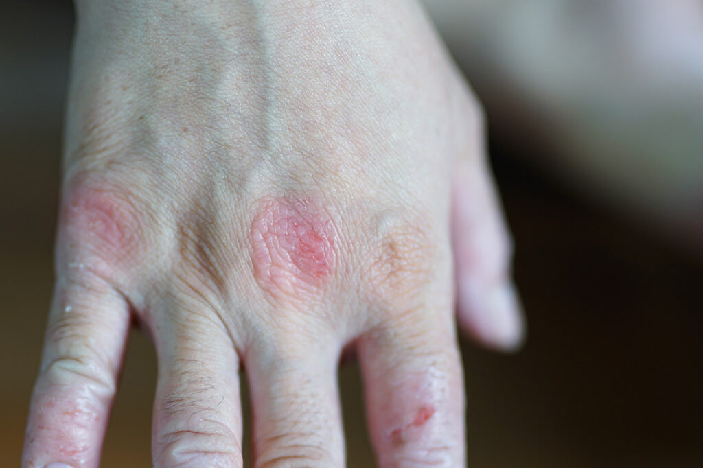 A man suffering from drug allergies