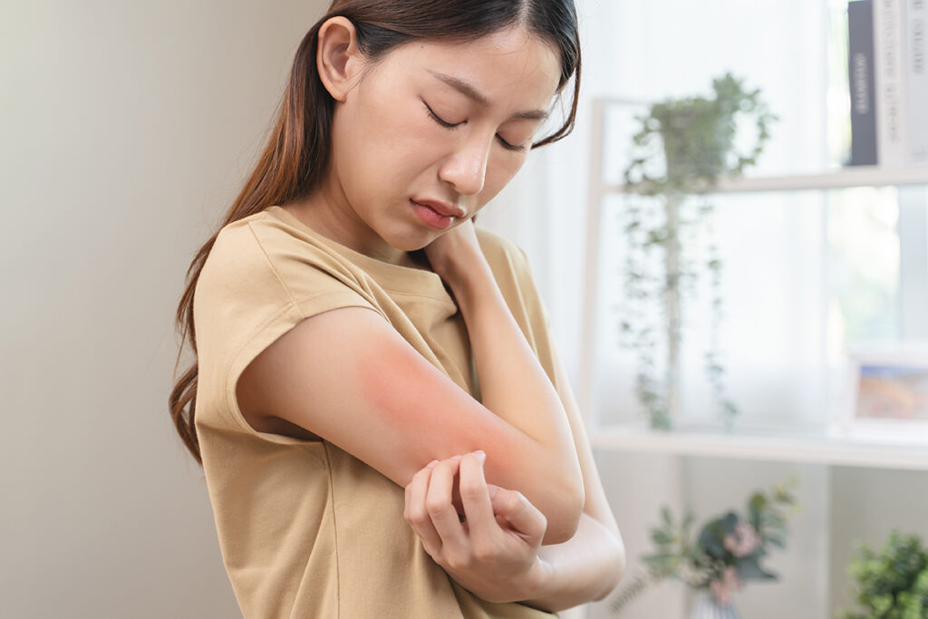 A woman suffering from chronic urticaria skin rash.