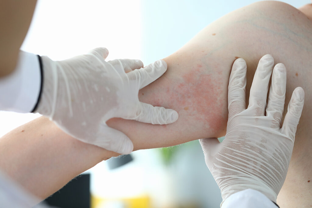 A doctor examining a patient’s hive outbreak.