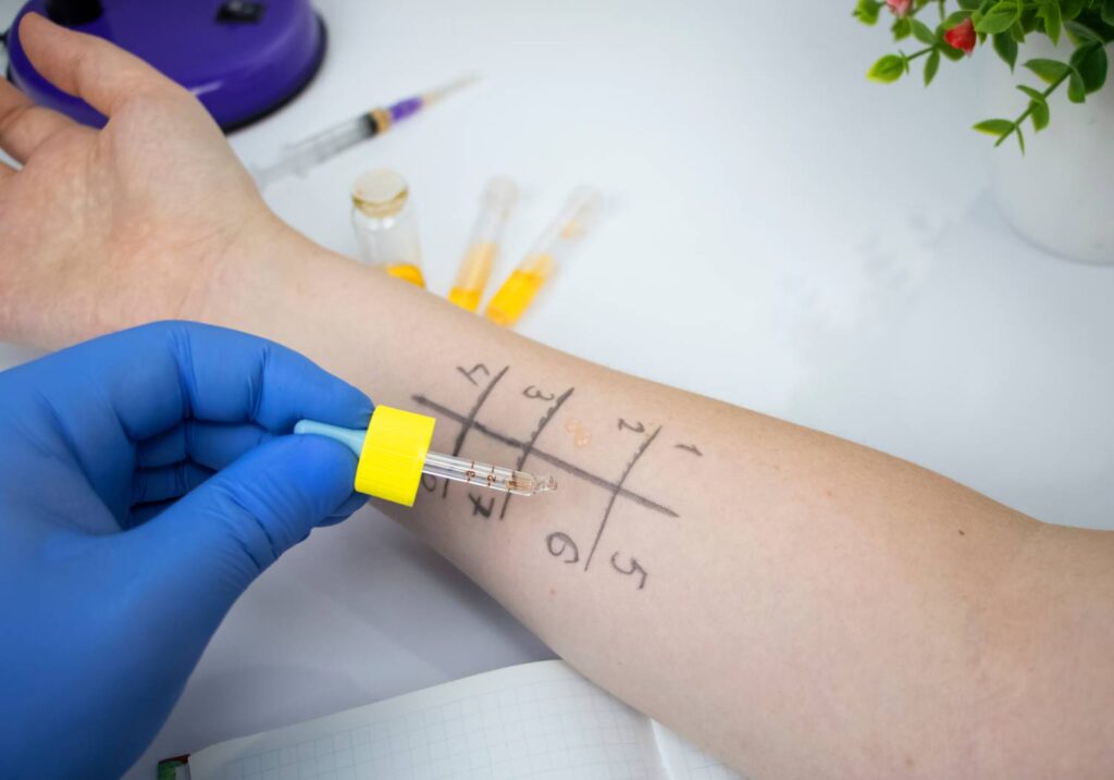 An allergy test in progress