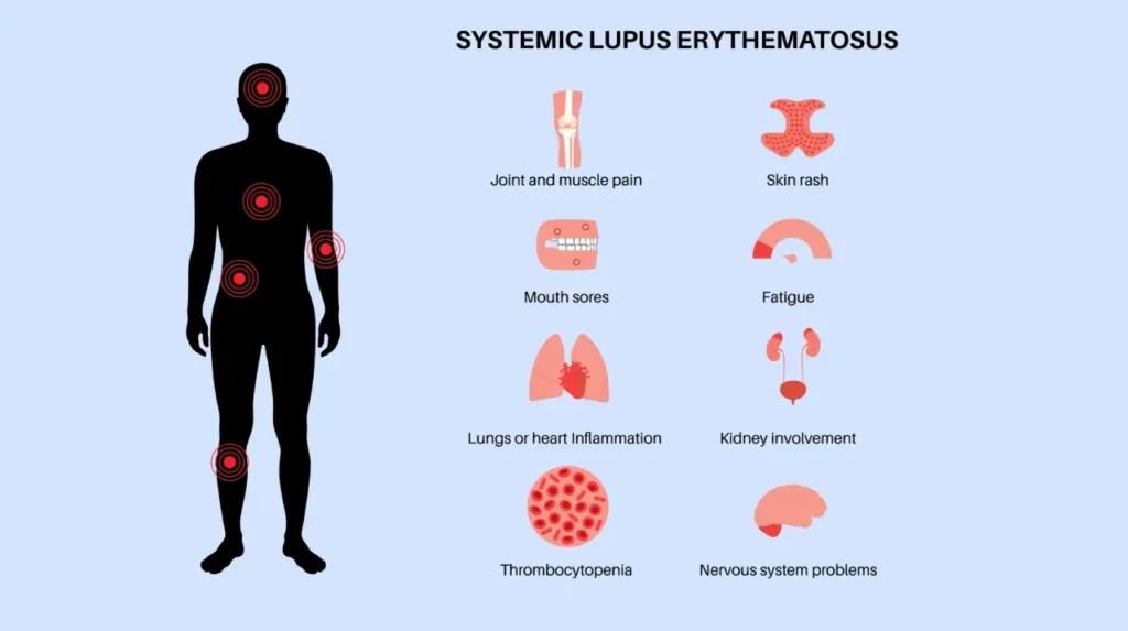 Lupus is a systemic autoimmune disease affecting multiple organs.
