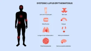 Lupus is a systemic autoimmune disease affecting multiple organs.
