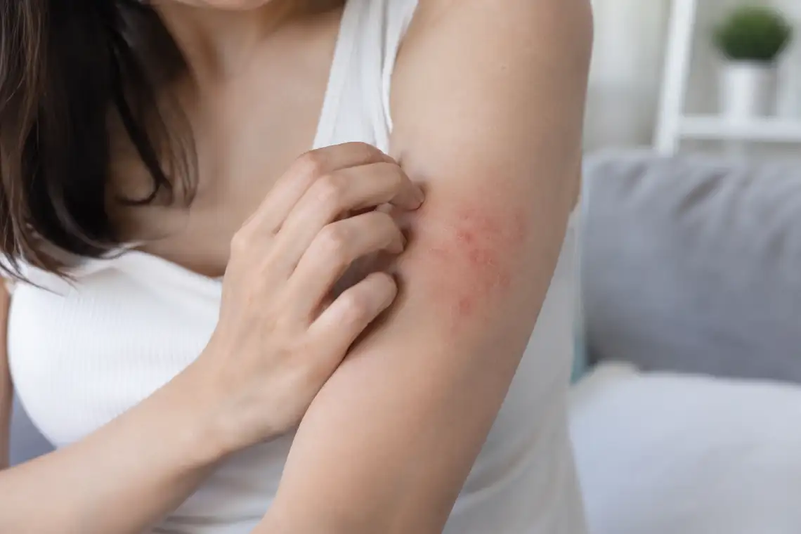 What Do Recurrent Rashes Look and Feel Like?