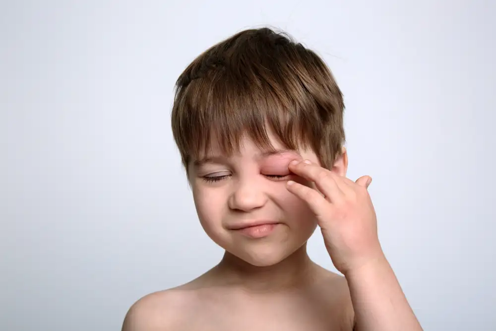 What Is Angioedema?