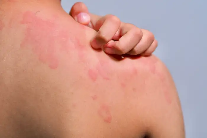 What is Urticaria?