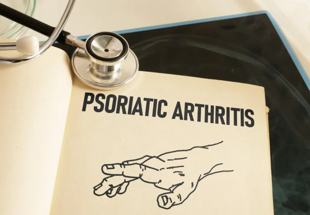 Paper with text “psoriatic arthritis” and an illustration of a hand with swollen fingers