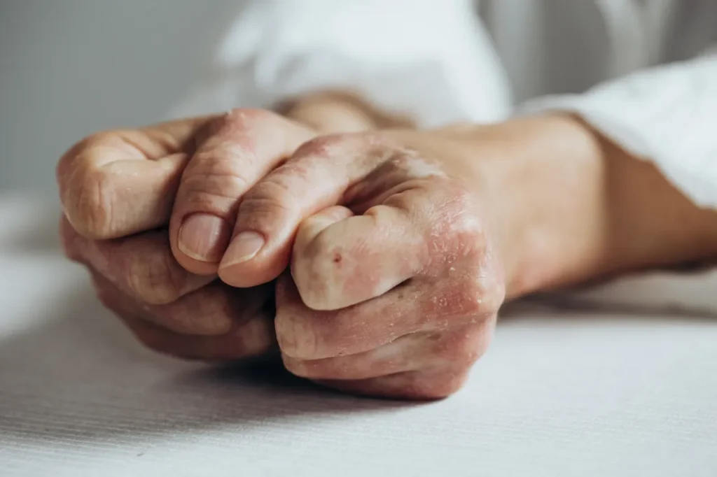 A pair of hands with swollen fingers and rashes on the knuckles